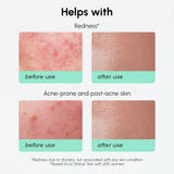Redness Soothing Azelaic Acid Serum